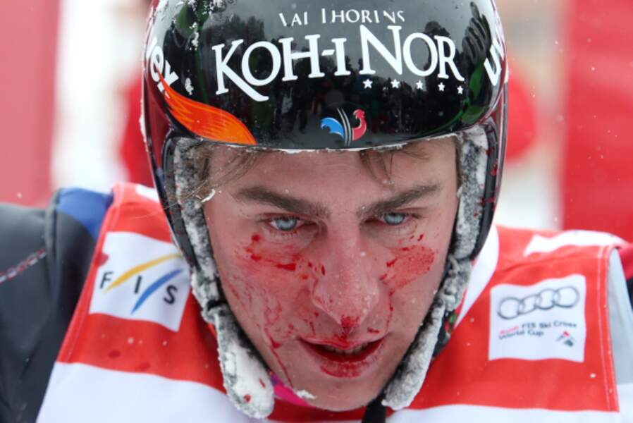 Touché au nez, le champion olympique J-F. Chapuis a remporté l'ultime épreuve de la coupe du monde de skicross.